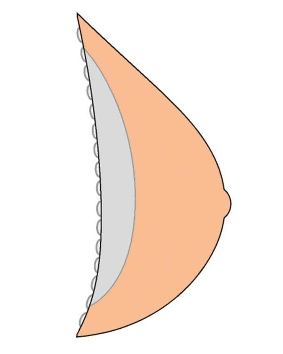 Amoena Contact 3E 386CT Breast Form - Tawny